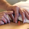 Acupuntura